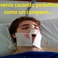 Rinoplastia elquechuga